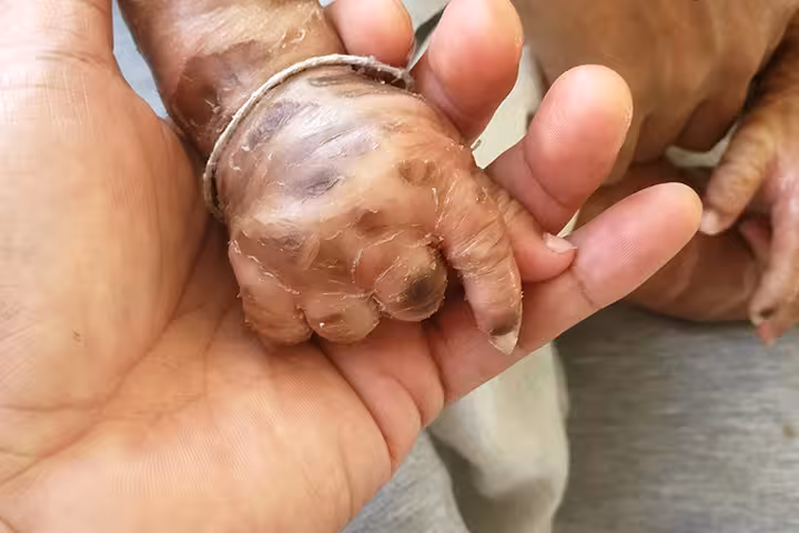 Harlequin Ichthyosis Baby