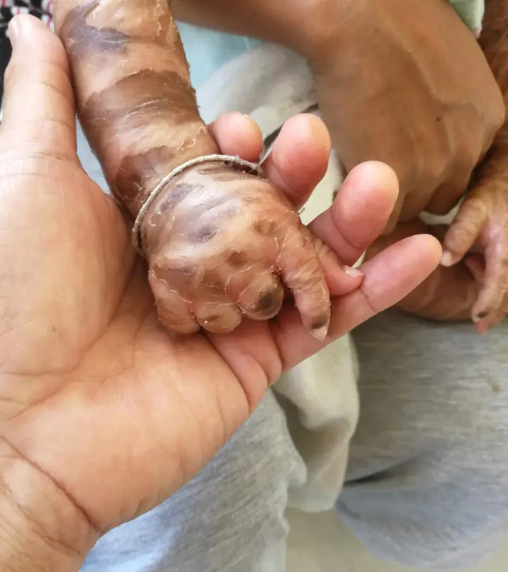 Harlequin Ichthyosis Baby