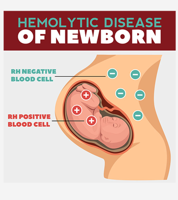 Hemolytic Disease of the Newborn (HDN) Causes And Treatment