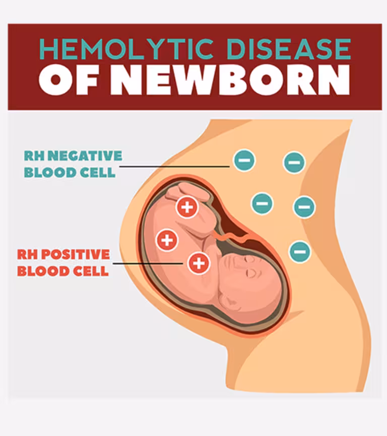 Hemolytic Disease of the Newborn (HDN) Causes And Treatment