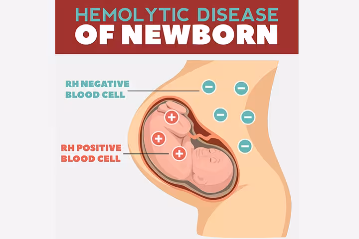 Hemolytic Disease of the Newborn (HDN) Causes And Treatment