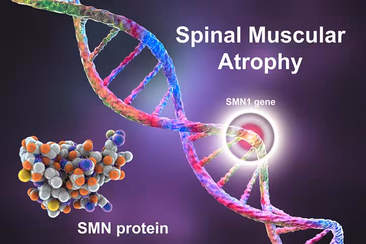 Spinal Muscular Atrophy in Infants Types, Causes And Management-1