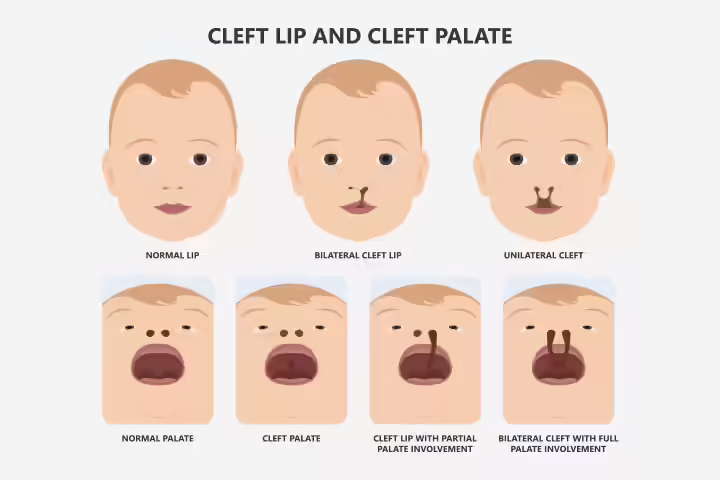 Baby with cleft lip Baby with cleft lip