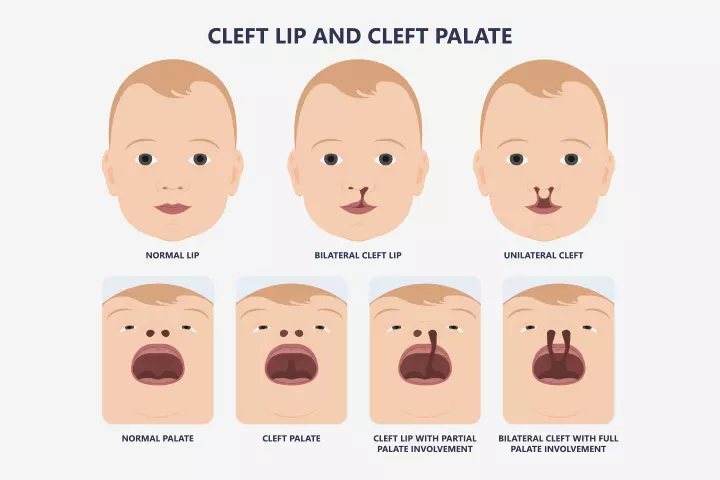 Baby with cleft lip