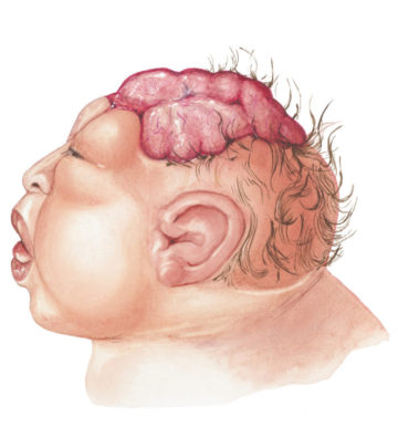 Anencephaly In Babies Causes, Symptoms And Treatment