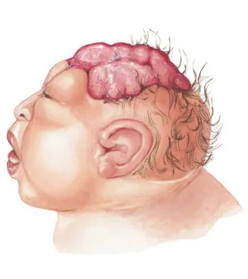 Neural tube defects can be the reason for open skull bone at the back of the head.