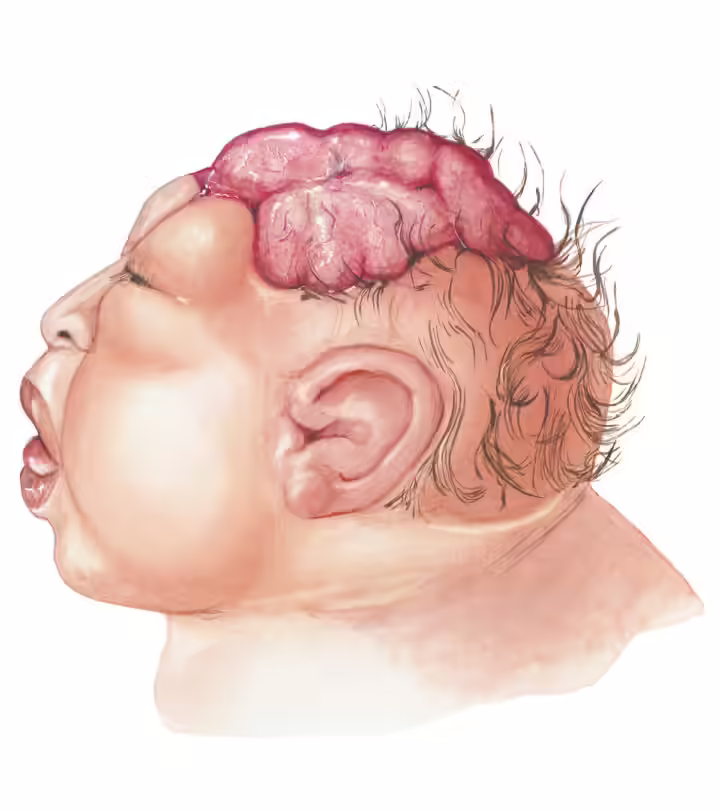 Anencephaly In Babies Causes, Symptoms And Treatment