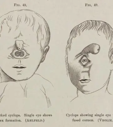 Cyclopia is rare but certain risk factors are associated with it.