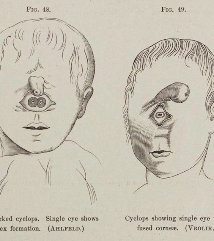 Cyclopia Baby: Causes, Diagnosis And Life Expectancy