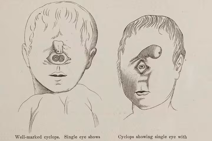 Cyclopia Baby: Causes, Diagnosis And Life Expectancy