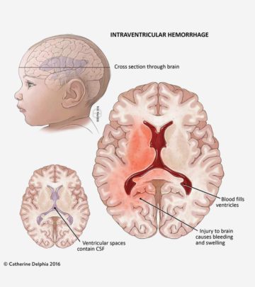 Certain infections and genetic disorders can rupture the blood vessels, resulting in bleeding.