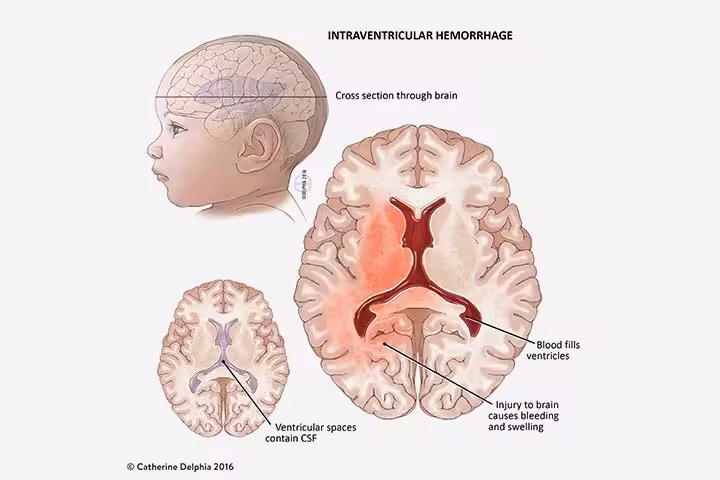 Intraventricular Hemorrhage (IVH) In Newborns Causes And Treatment