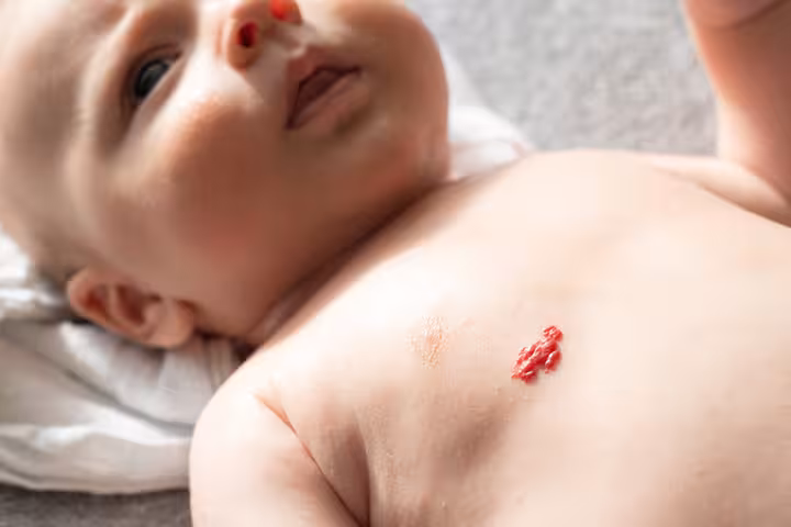 Moles In Babies