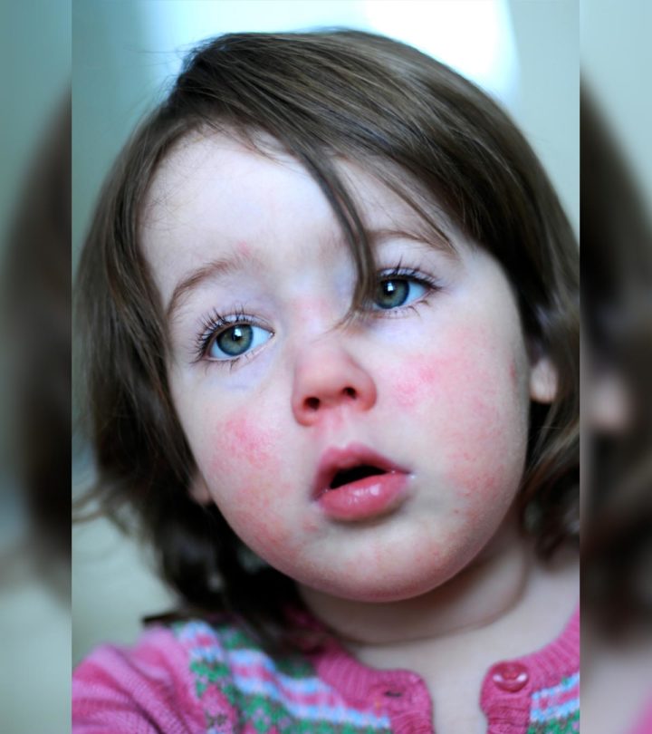 Scarlet Fever In Children Symptoms, Causes, Risks, And Treatment