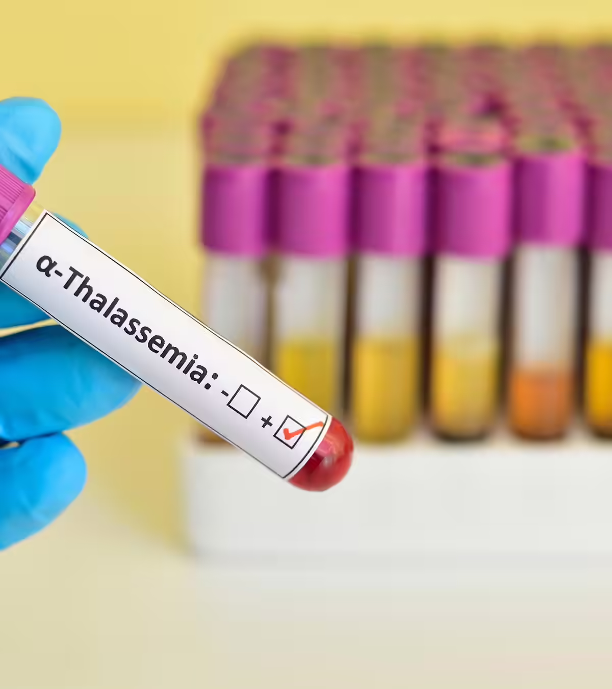 Thalassemia in Pregnancy in Hindi