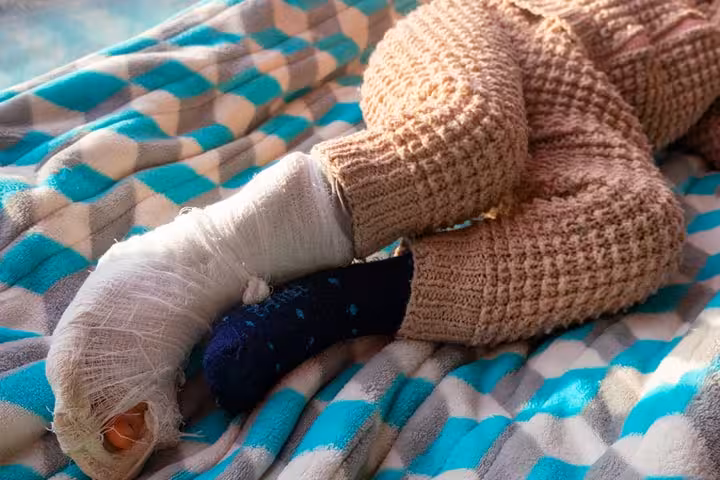 Toddler\'s Fracture: Causes, Symptoms, And Treatment