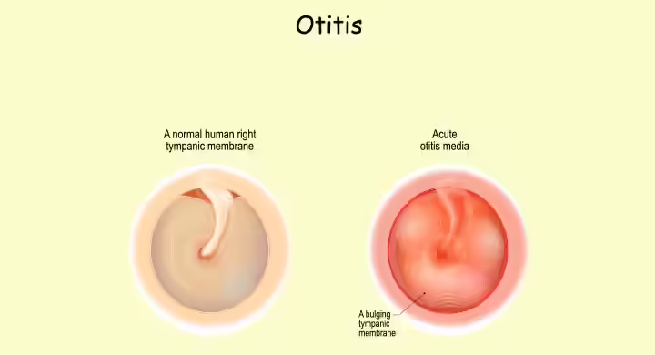 Acute otitis media in children Acute otitis media in children