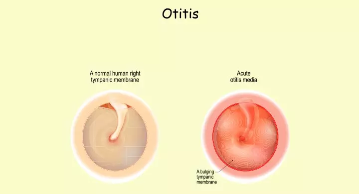 Acute otitis media in children