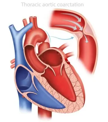 Irregular heart and breathing patterns may be common in babies with this condition.