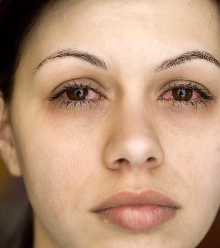 Conjunctivitis During Pregnancy In Hindi
