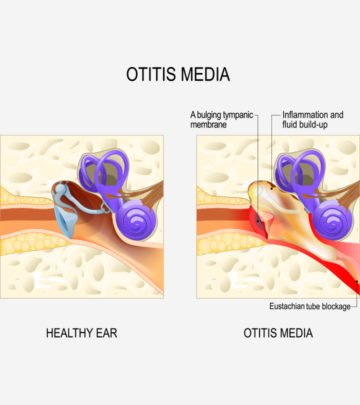 Otitis Media (Middle Ear Infection) In Children Types, Symptoms, And Treatment