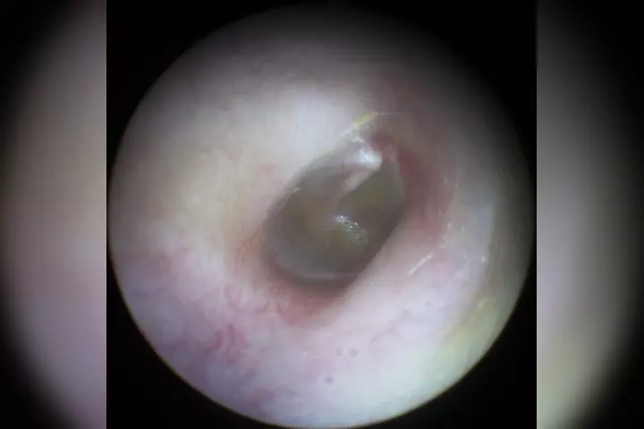 Otitis media with effusion in children