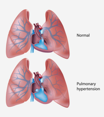 Persistent Pulmonary Hypertension Of The Newborn