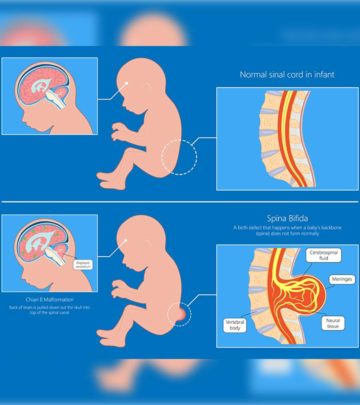 The symptoms are often visible right at birth, letting initiation of treatment.