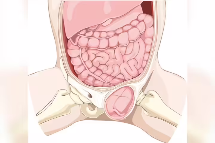 Inguinal hernia in children Inguinal hernia in children