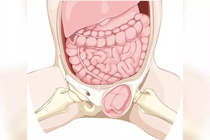 Inguinal hernia in children