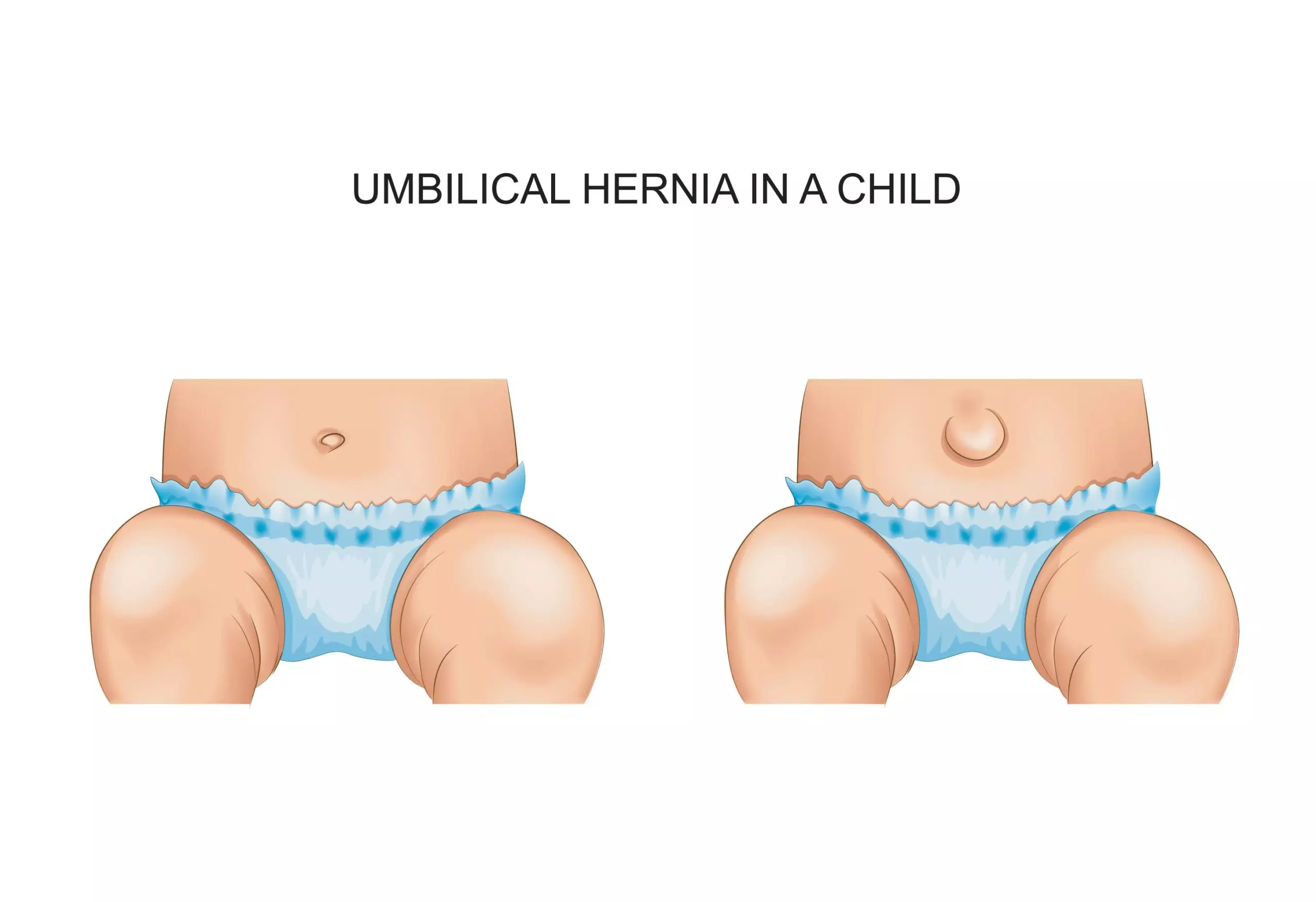 Umbilical hernia in children