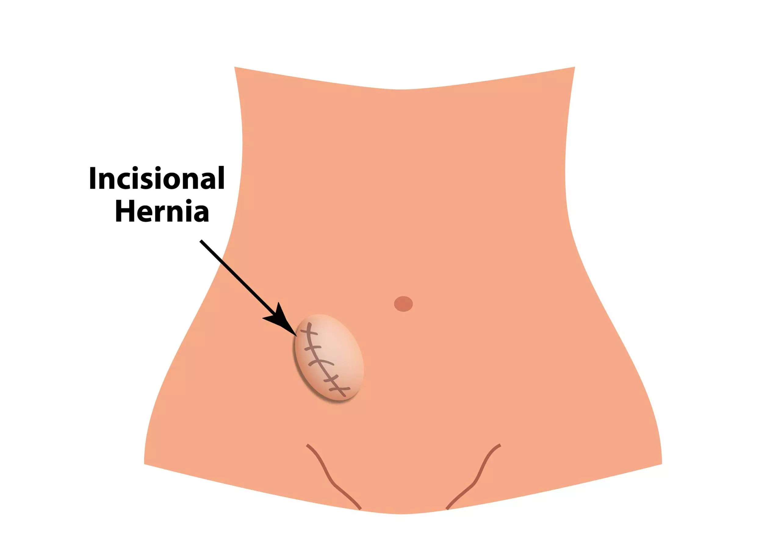 Incisional hernia in children