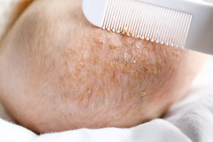 Cradle cap or scab