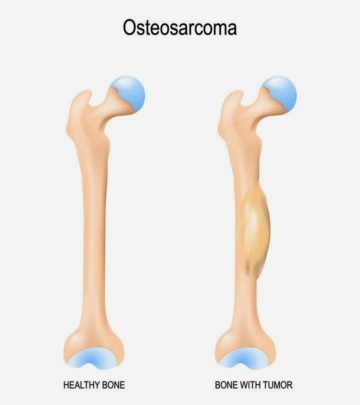 Osteosarcoma In Children Types