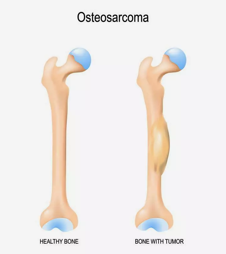 Osteosarcoma In Children Types