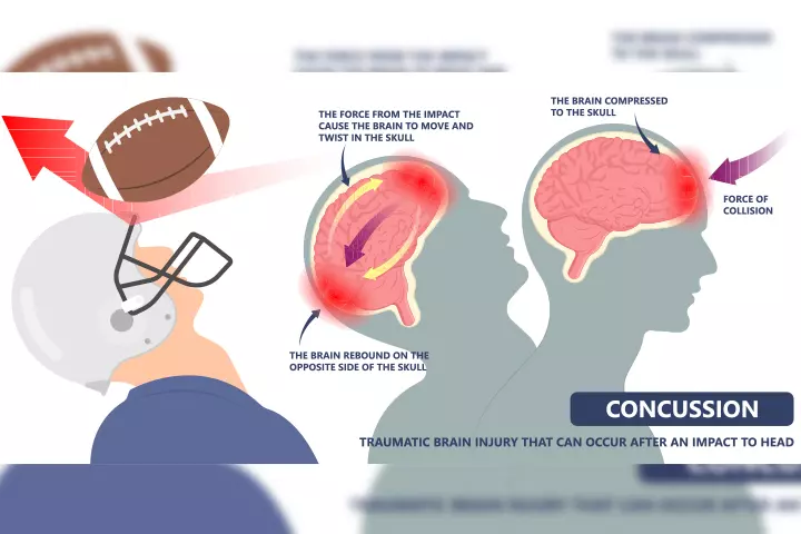 Concussions in teens