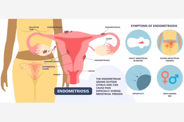 Signs and symptoms of endometriosis in teens Signs and symptoms of endometriosis in teens