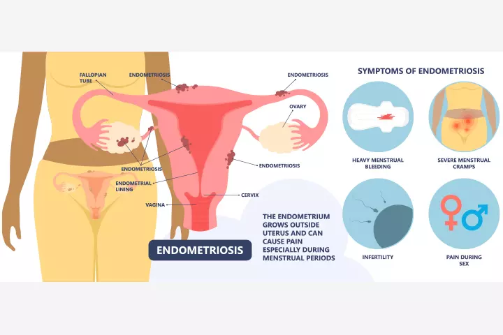 Signs and symptoms of endometriosis in teens