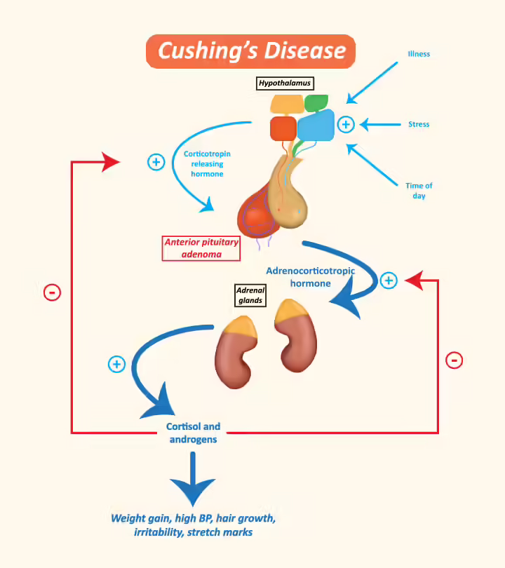 Cushing Syndrome In Children: Causes, Symptoms, Treatment, And Care