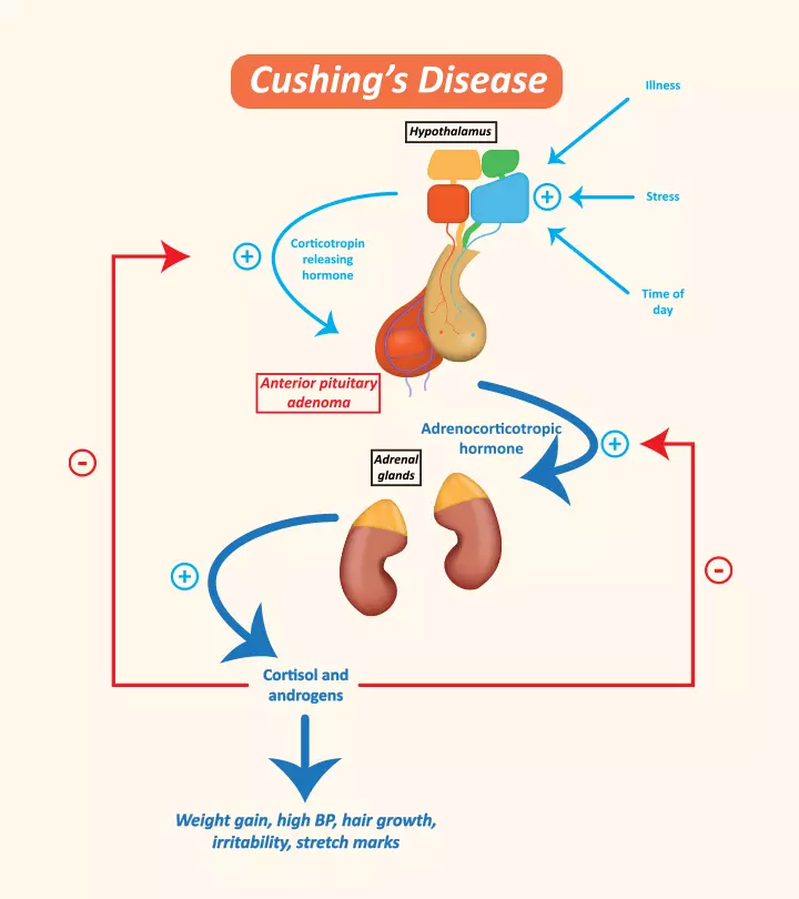 Cushing Syndrome In Children: Causes, Symptoms, Treatment,  And Care