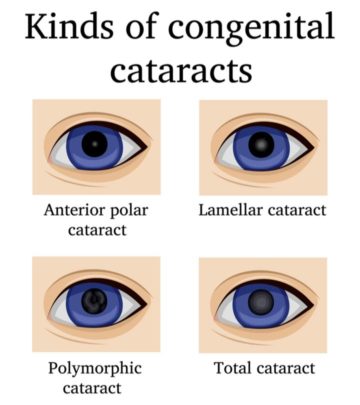 Cataracts may occur alone or can be linked to other conditions, and the symptoms may vary depending on the cause.