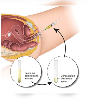 The symptoms of a successful pregnancy after IUI are similar to that of a normal pregnancy.