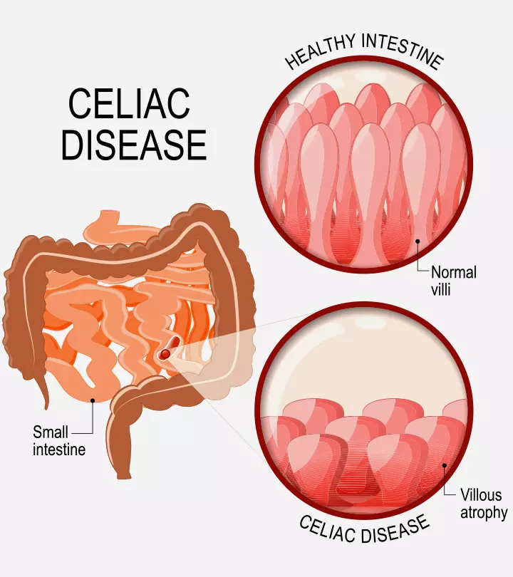 Celiac Disease In Children Causes, Symptoms, Diagnosis, And Treatment