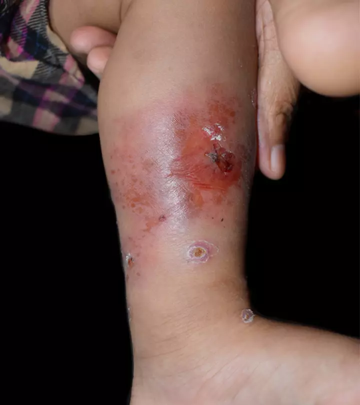 Cellulitis In Children: Causes, Symptoms, Treatment And Prevention