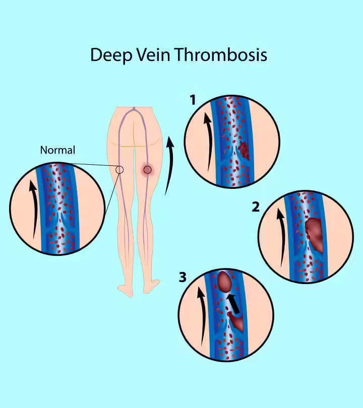 Deep Vein Thrombosis (DVT) In Pregnancy Symptoms And Treatment