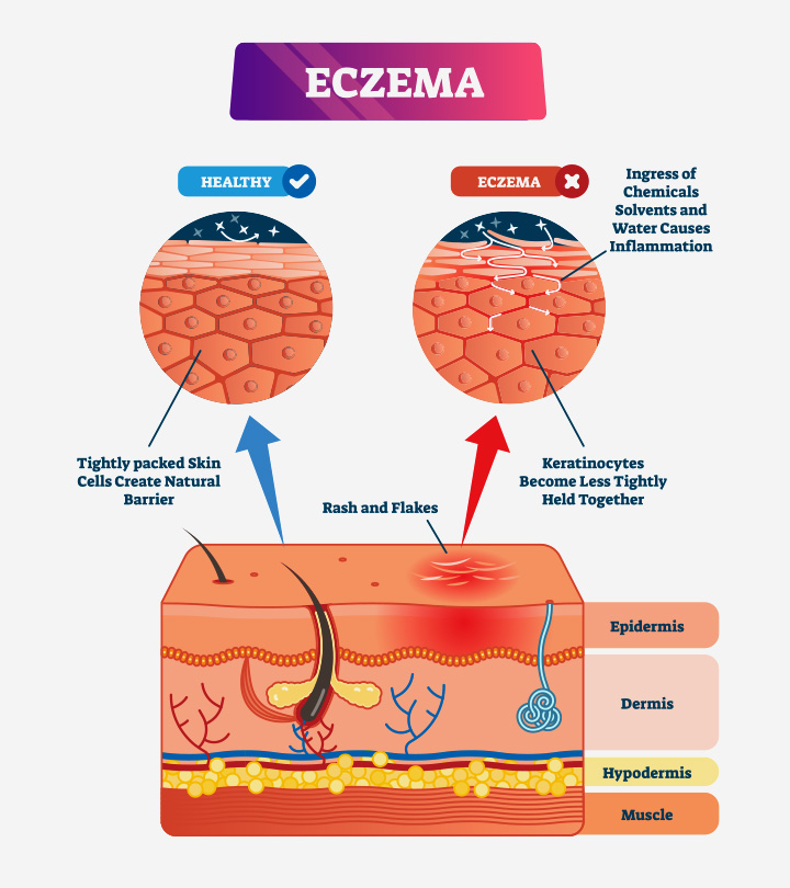 Eczema During Pregnancy Causes, Treatment And Home Remedies