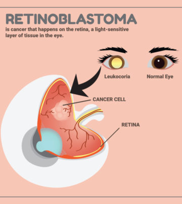 If a flash causes white eyes in a photograph instead of red, it can indicate retinoblastoma.