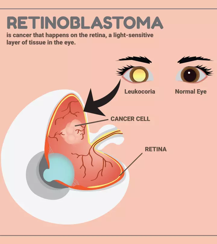 Eye Cancers (Retinoblastoma) In Children: Causes, Symptoms, And Treatment