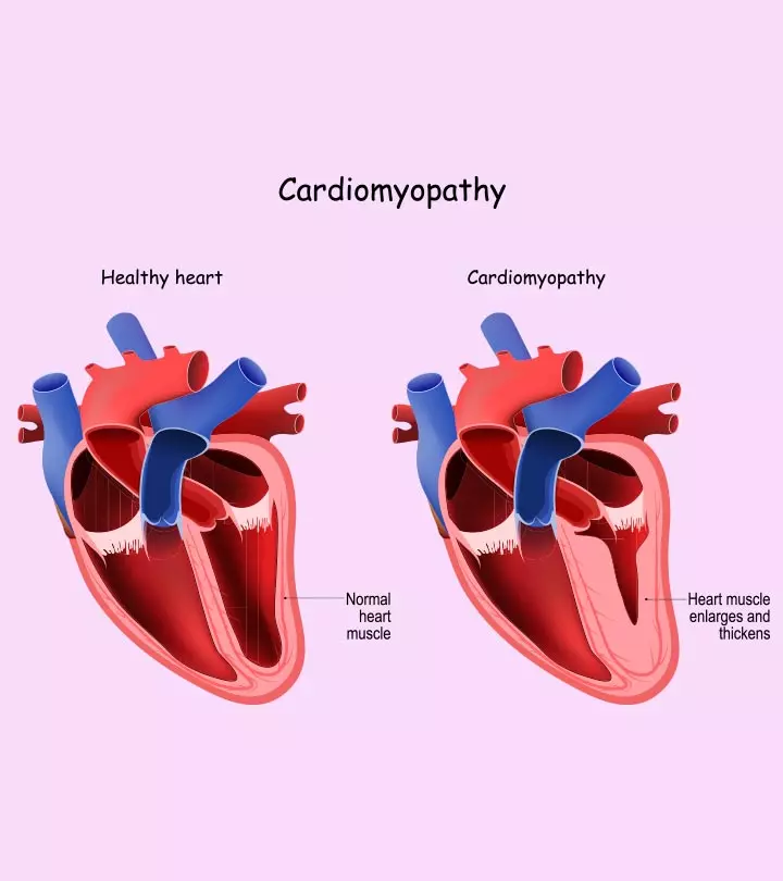 Peripartum Cardiomyopathy Causes, Diagnosis, And Treatment