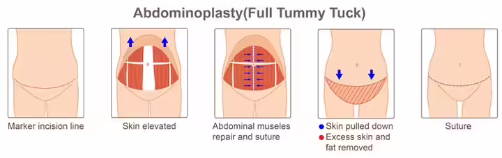 Process of full tummy tuck after C-section Process of full tummy tuck after C-section